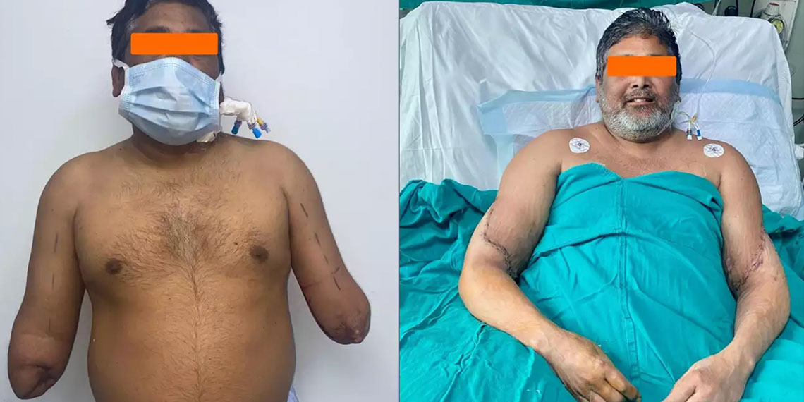 In Asia, indian doctors help painter get his hands back with first ever successful bilateral transpl